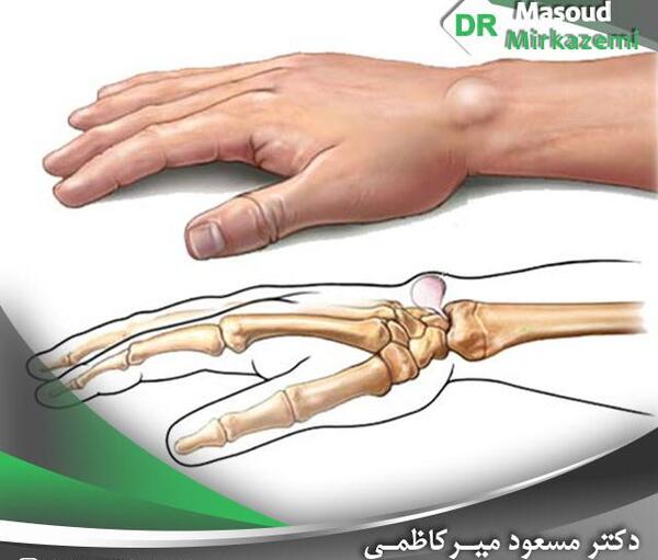 عکس ام ار ای مچ دست