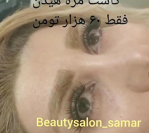 عکس کاشت هیدن