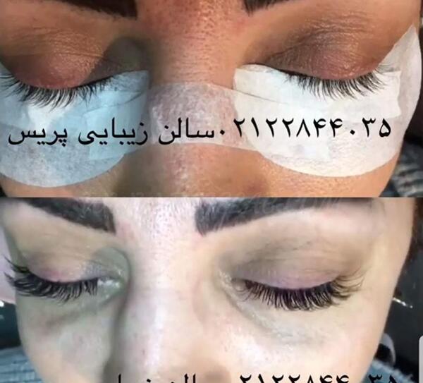 عکس کاشت هیدن
