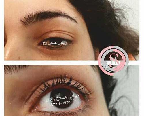 عکس کاشت هیدن