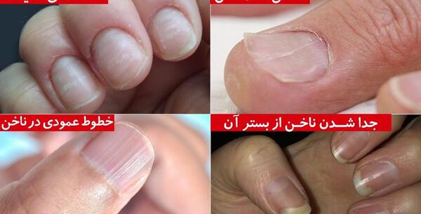 عکس ناخن قاشقی