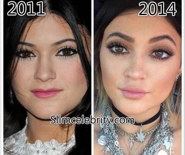 عکس قبل عمل kylie jenner