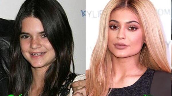 عکس قبل عمل kylie jenner