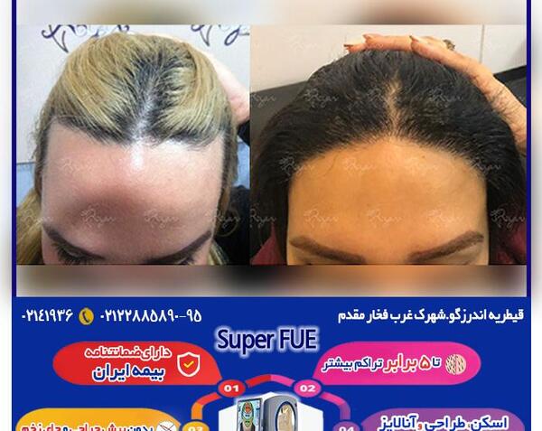 عکس کاشت مو قبل و بعد