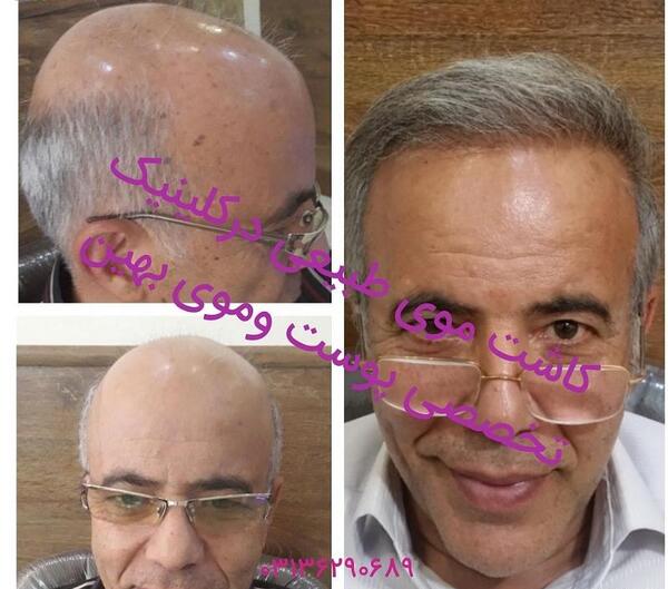 عکس کاشت مو قبل و بعد