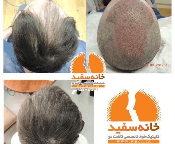 عکس کاشت مو شهاب حسینی