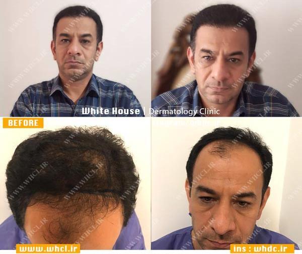 عکس کاشت مو شهاب حسینی