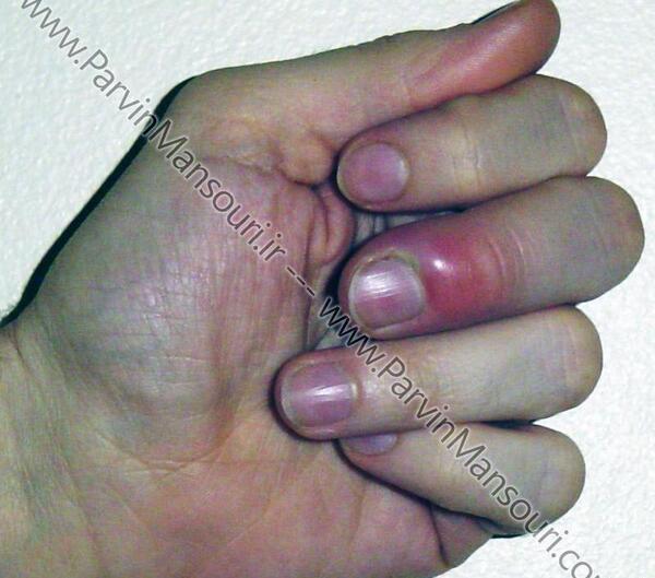عکس ناخن چرک