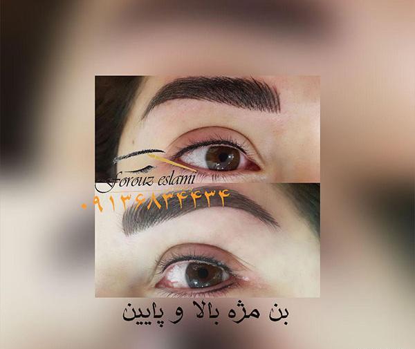 عکس کاشت بن مژه