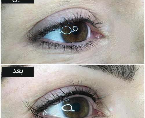 عکس کاشت بن مژه