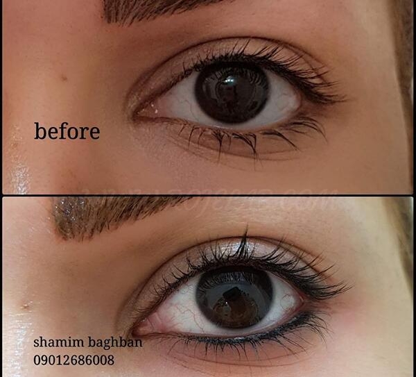 عکس کاشت بن مژه