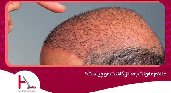 عکس عفونت کاشت مو
