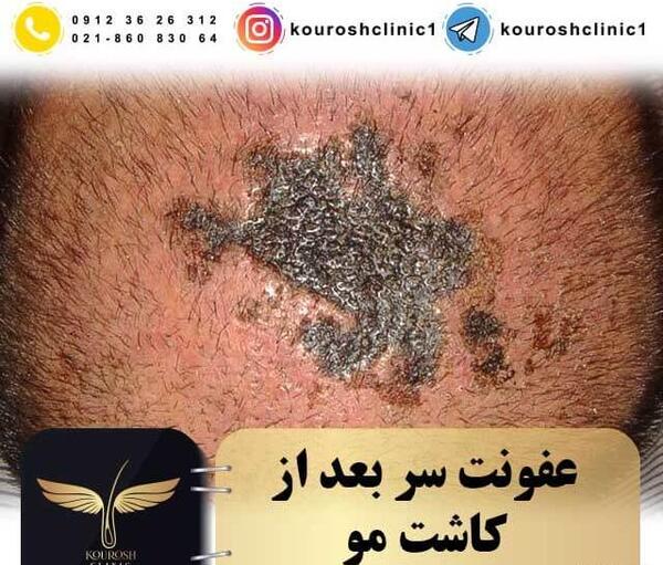 عکس عفونت کاشت مو