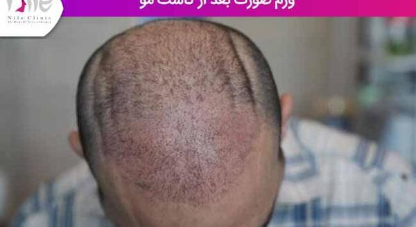 عکس عفونت کاشت مو