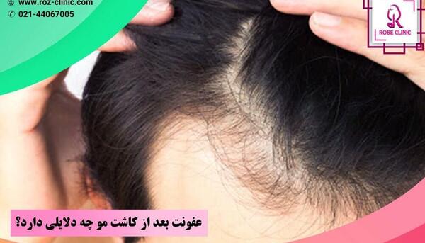عکس عفونت کاشت مو