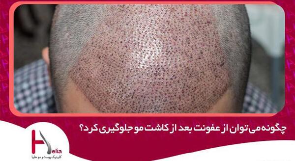عکس عفونت کاشت مو