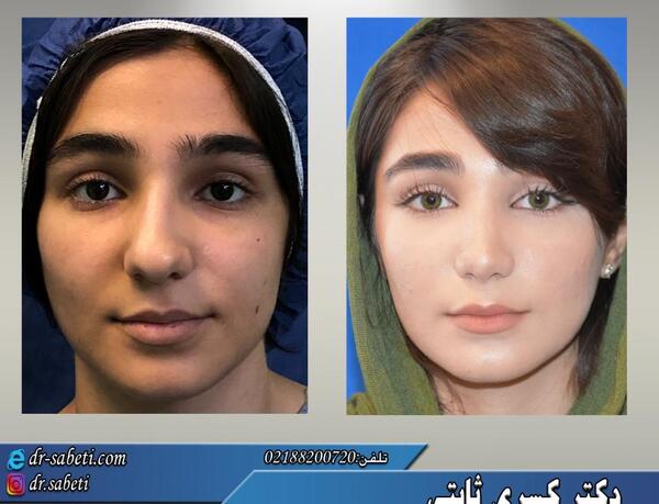 عدم تقارن صورت در عکس نی نی سایت