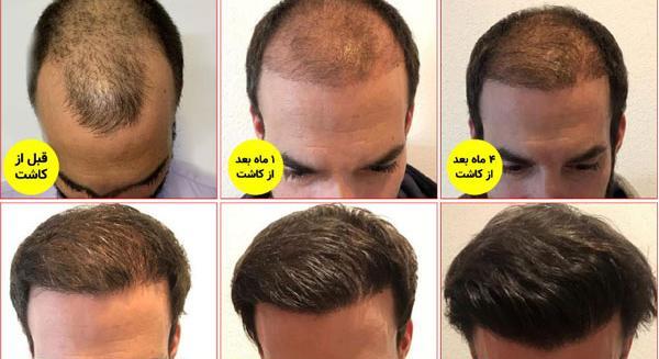 عکس کاشت مو بعد از یک ماه