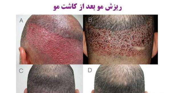 عکس کاشت مو بعد از یک ماه