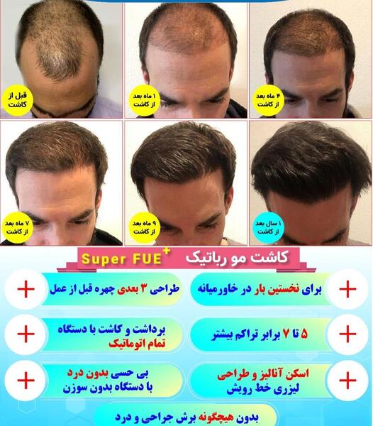 عکس کاشت مو بعد از یک ماه