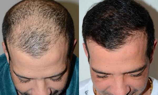 عکس کاشت مو بعد از یک ماه