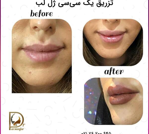 عکس تزریق ژل لب یک سی سی