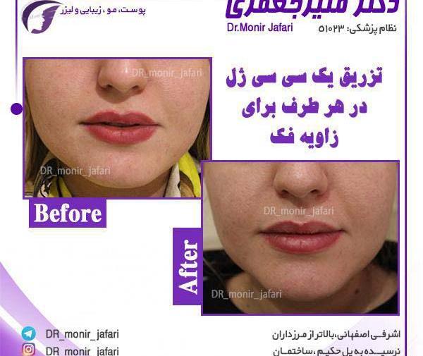 عکس تزریق ژل لب یک سی سی