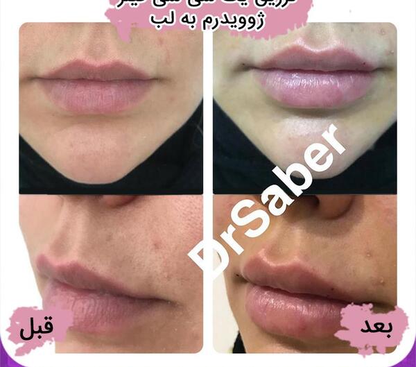 عکس تزریق ژل لب یک سی سی