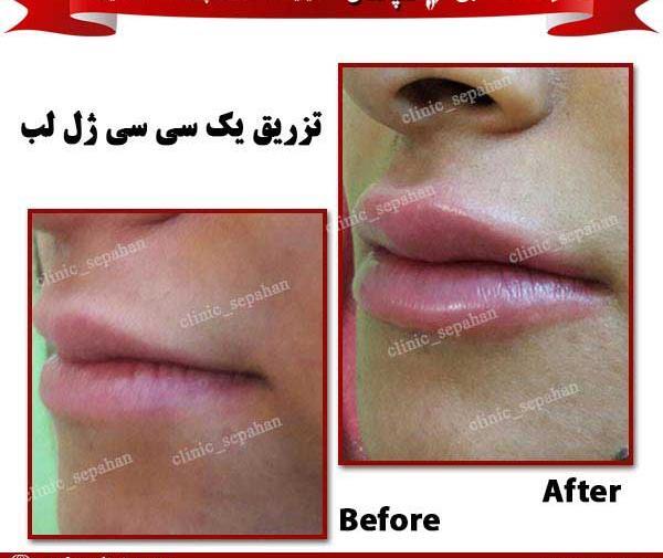 عکس تزریق ژل لب یک سی سی