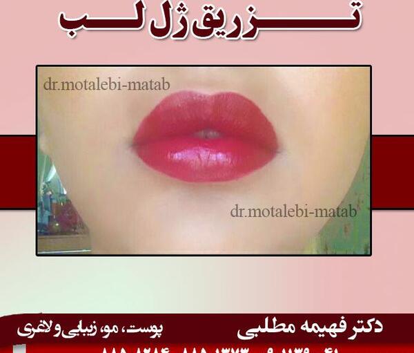عکس تزریق ژل لب یک سی سی