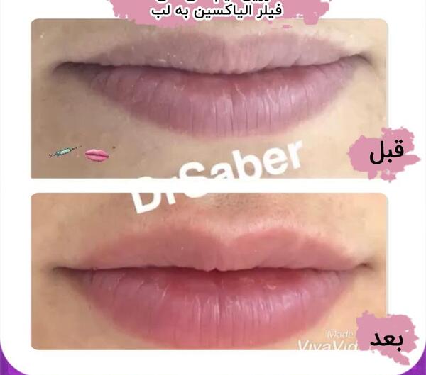 عکس تزریق ژل لب یک سی سی