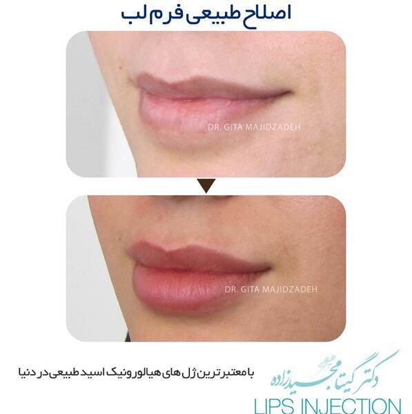 عکس تزریق ژل لب یک سی سی