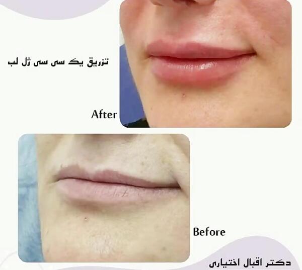عکس تزریق ژل لب یک سی سی