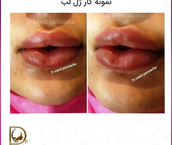 عکس تزریق ژل لب یک سی سی