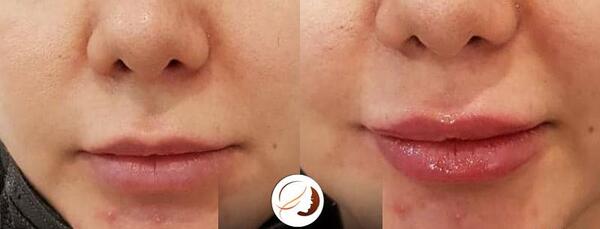 عکس تزریق ژل لب یک سی سی