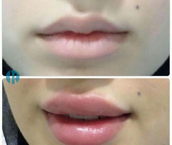 عکس تزریق ژل لب یک سی سی