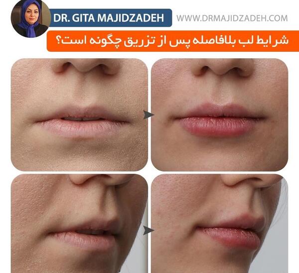 عکس تزریق ژل لب یک سی سی