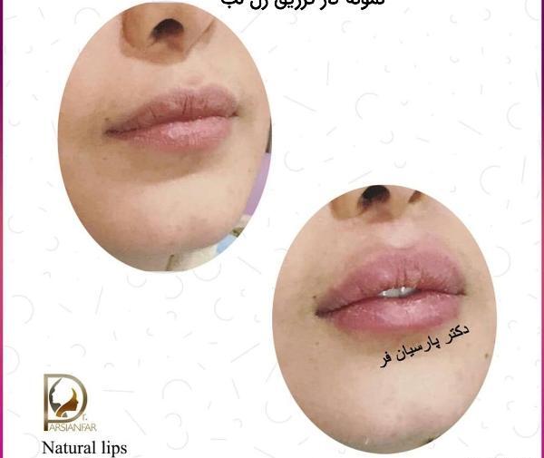 عکس تزریق ژل لب یک سی سی