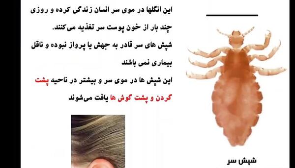 عکس شپش بدن