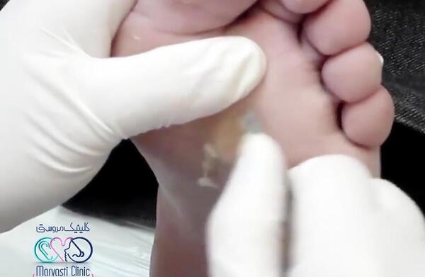 عکس ریشه میخچه پا