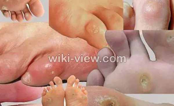 عکس ریشه میخچه پا
