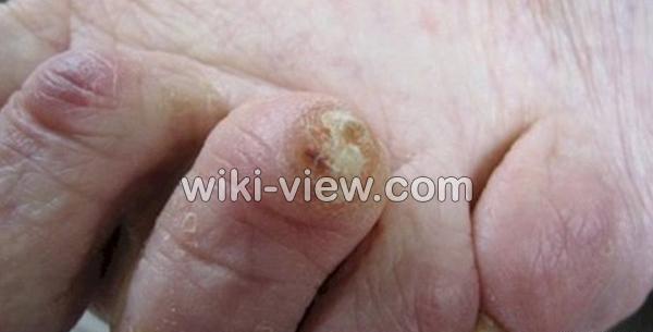 عکس ریشه میخچه پا