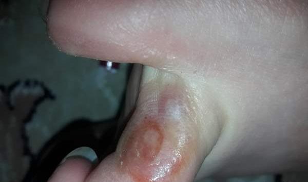 عکس ریشه میخچه پا