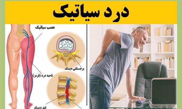 عصب سياتيك عکس ام ار ای دیسک کمر خفیف