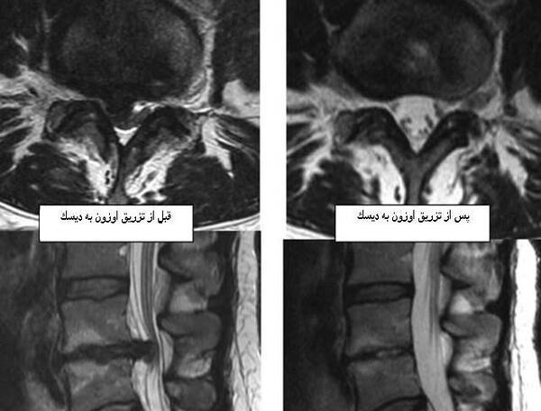 عصب سياتيك عکس ام ار ای دیسک کمر خفیف