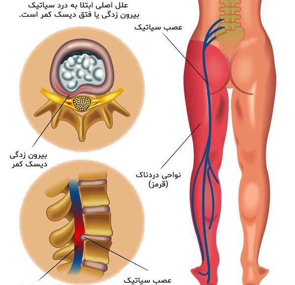 عصب سياتيك عکس ام ار ای دیسک کمر خفیف