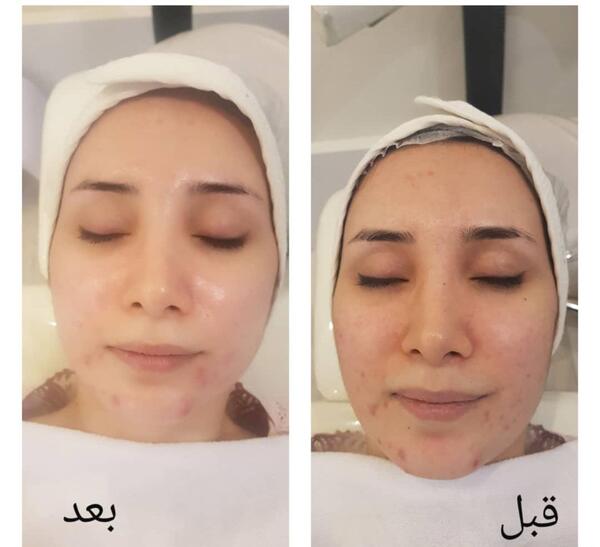 عکس قبل و بعد پاکسازی صورت