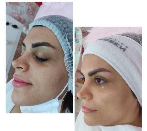 عکس قبل و بعد پاکسازی صورت