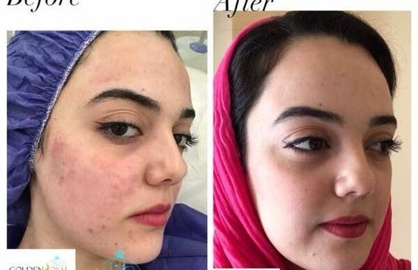 عکس قبل و بعد پاکسازی صورت
