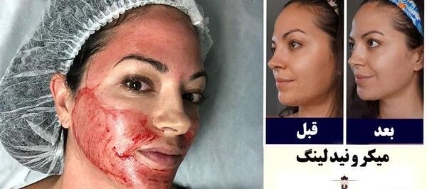عکس قبل و بعد پاکسازی صورت